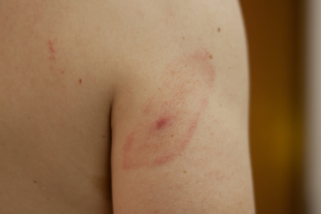 Erythema migrans na tekenbeet
